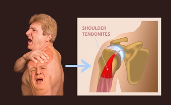 Вредные упражнения после 40 и не только. Часть 1. Правильное упражнение лечит, неправильное - калечит.